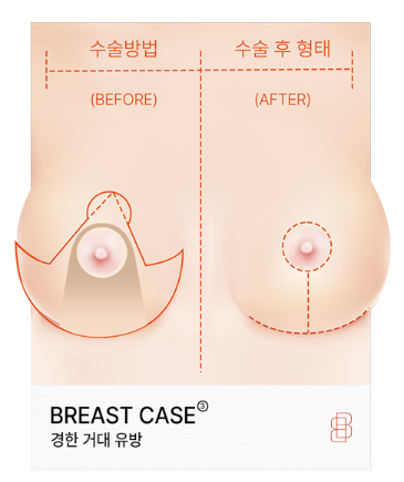 크고 처진 가슴도 가슴축소수술로 나에게 맞는 크기로 - 봉봉성형외과 관련 이미지 5