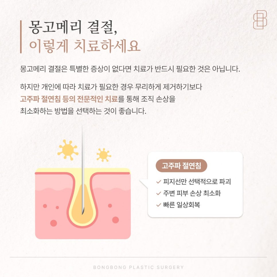 몽고메리결절 유두 유륜 정상 범위와 제거를 결정하는 기준 4가지 관련 이미지 4