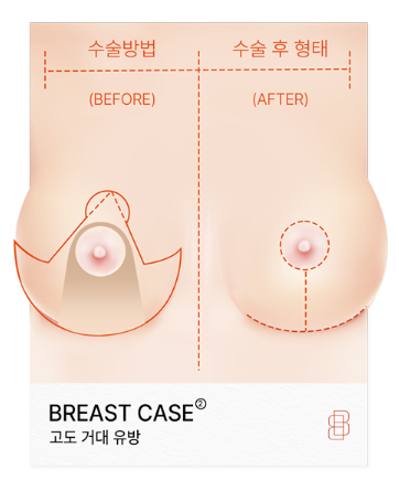 크고 처진 가슴도 가슴축소수술로 나에게 맞는 크기로 - 봉봉성형외과 관련 이미지 7