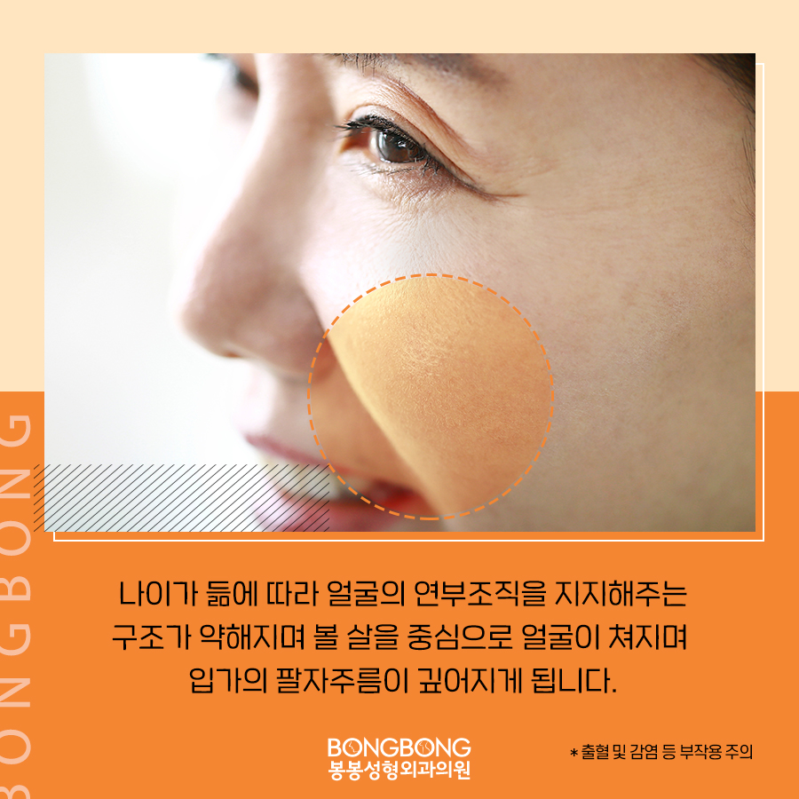 자연스러운 주름개선, 안면거상술 효과가 궁금하면? 관련 이미지 3