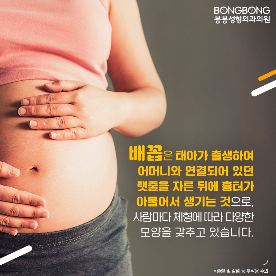 참외배꼽 콤플렉스라면 봉봉성형외과의 배꼽성형 관련 이미지 2