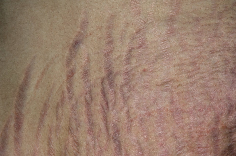 붉은튼살 레이저 치료 주사 바늘 없는 미라젯이란? 관련 이미지 3