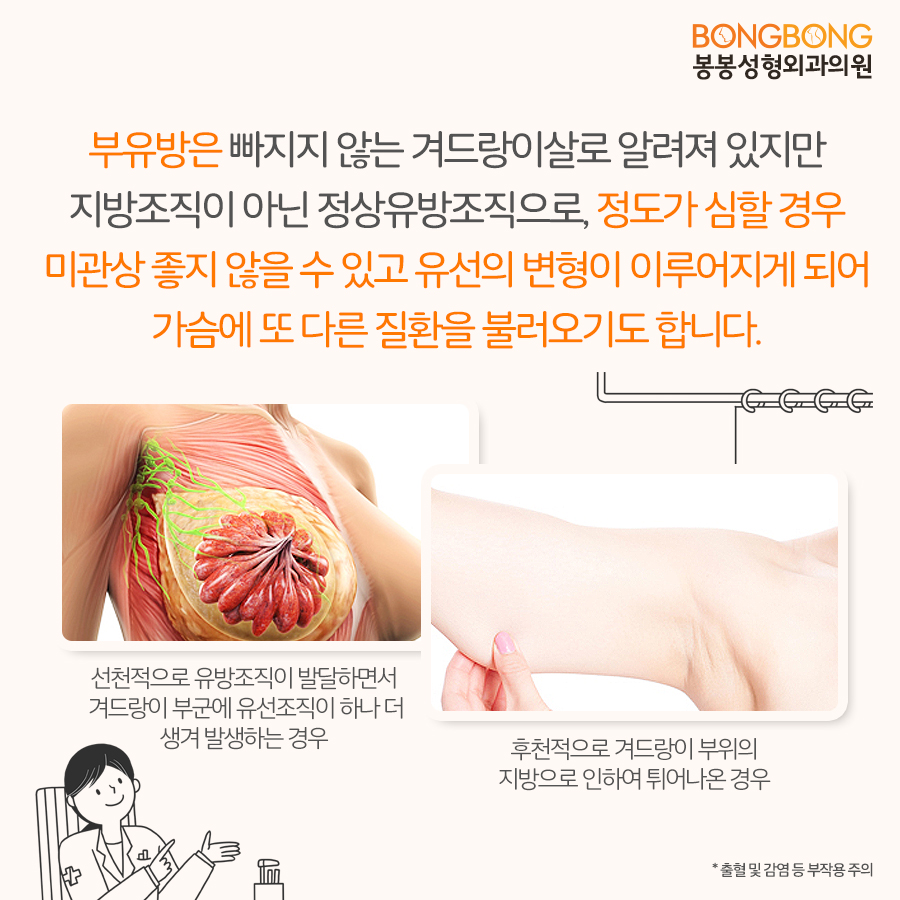 부유방제거 망설이지 말고 올 여름엔 당당하게 나시입기! 관련 이미지 3
