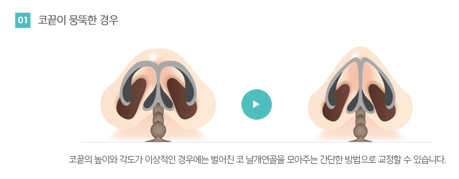 코끝성형후기 오똑한 콧날의 봉봉성형외과에서~ 관련 이미지 5