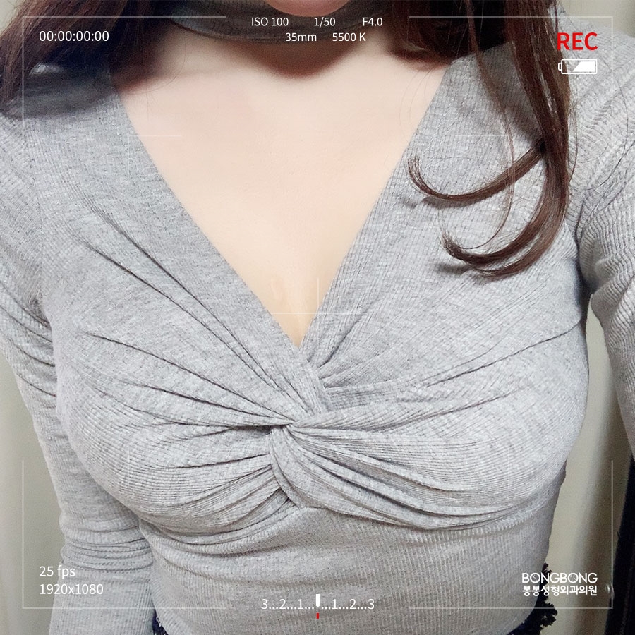 가슴확대성형, 이중평면ㆍ근막하 선택기준은? 관련 이미지 9