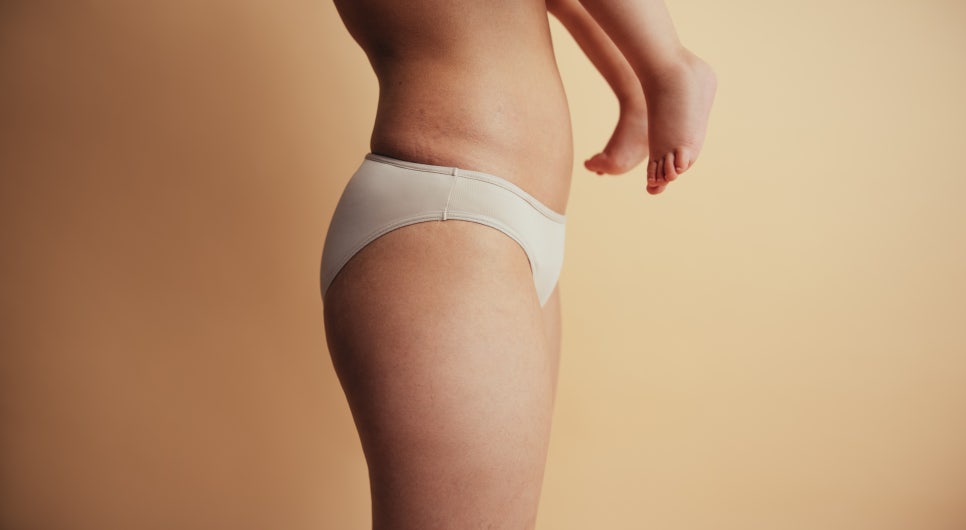 하얀 튼살 레이저, 미라젯 시술로 없애기 관련 이미지 6