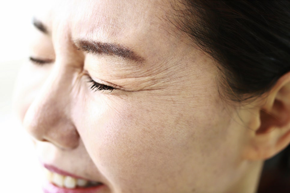 팔자주름, 처진 피부 개선 안면거상술 효과 관련 이미지 5