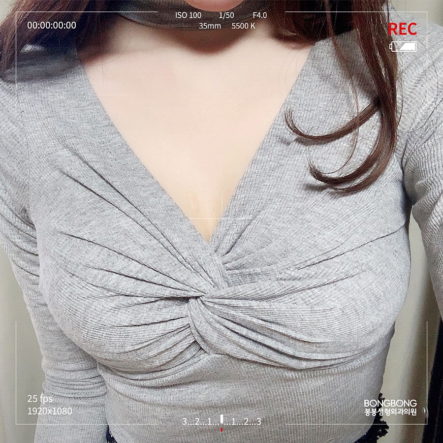 부유방빼기 및 통증 제거술을 통해 개선 관련 이미지 4