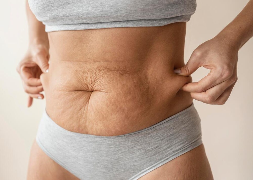 복부 튼살이 많은데 복부성형을 고민해도 괜찮을까요 관련 이미지 2