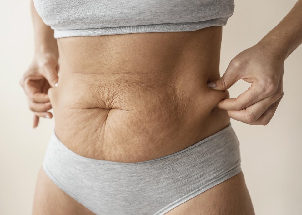 미니복부거상 비용은 어떻게 결정될까요, 선택 전 체크 포인트 관련 이미지 4