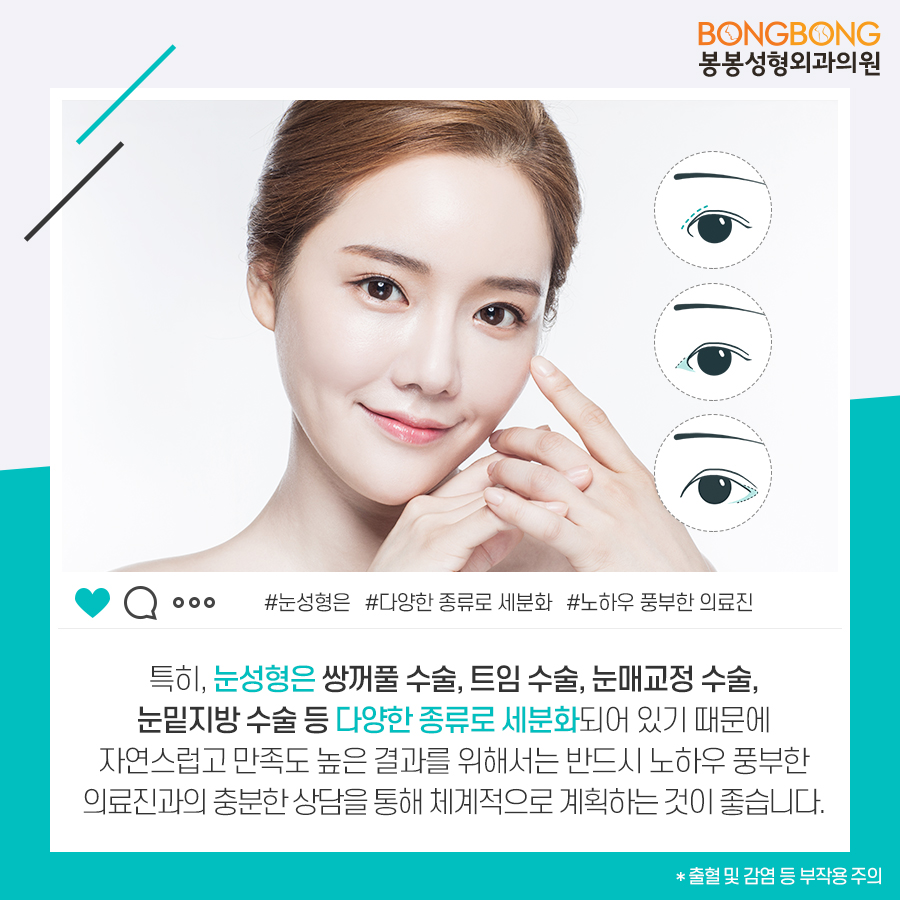 눈성형종류 중 내게 맞는 것 봉봉성형외과 관련 이미지 4