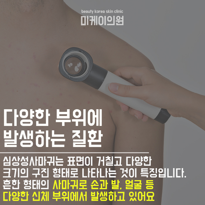 사마귀예방방법 어렵지 않은 이유 관련 이미지 2