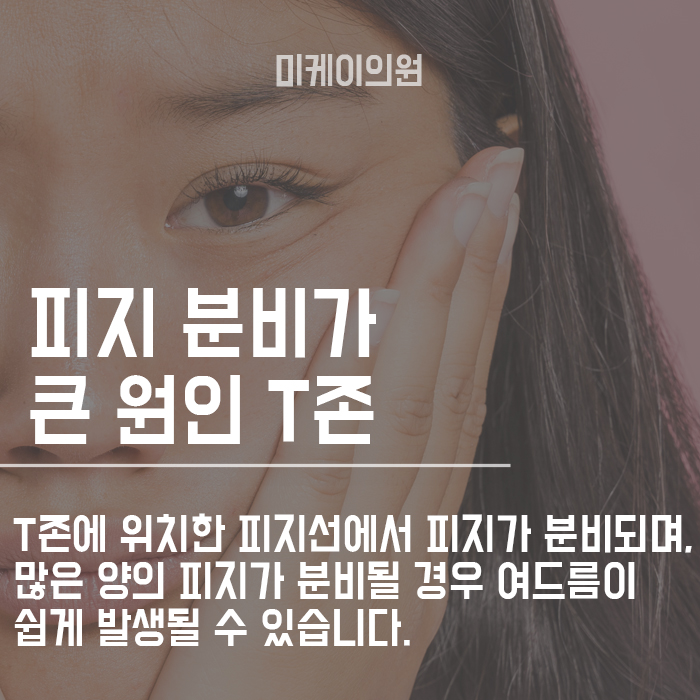 얼굴 부위별 여드름 원인 알고 관리해봐요 관련 이미지 2