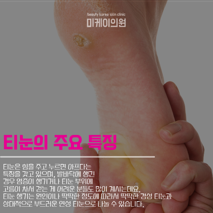 티눈생기는원인 및 케어법 알아보기 관련 이미지 3