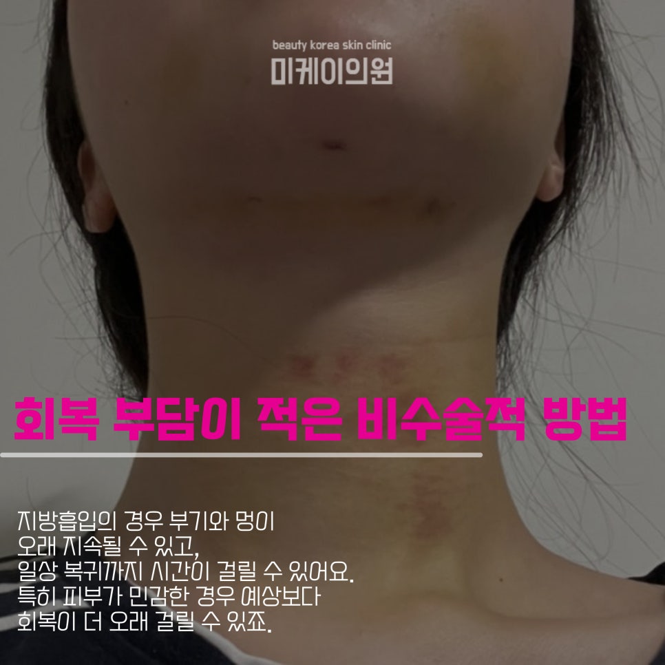 이중턱지방흡입부작용 피하려면 관련 이미지 4