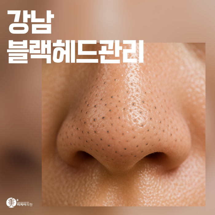 Clear and Smooth Skin with Aqua Peel for Blackhead Care in Gangnam image 1