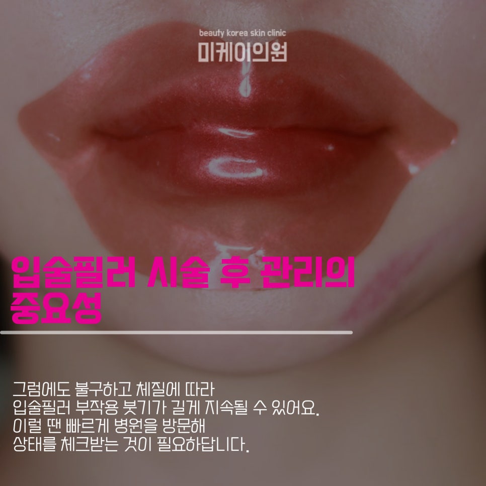 How to Avoid Swelling as a Lip Filler Side Effect image 4