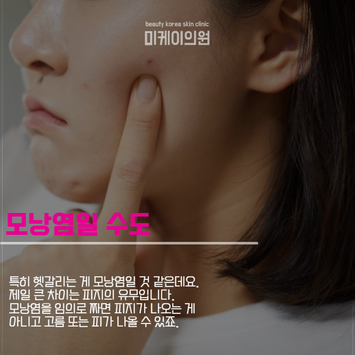 여드름 압출 방법 상처 생기지 않도록 관련 이미지 4
