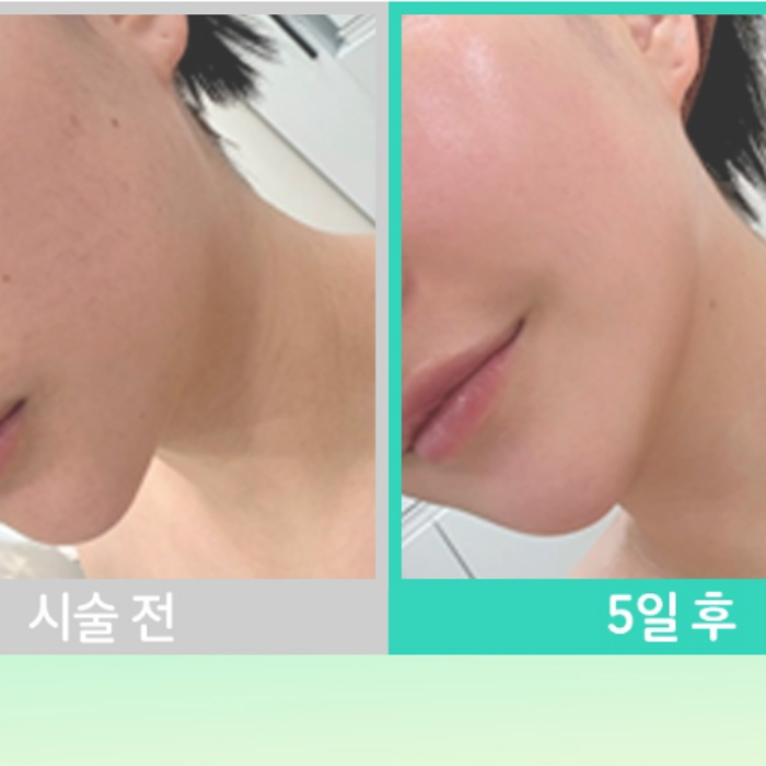 서초 울쎄라 병원 리프팅 시술의 원리와 효과 관련 이미지 7