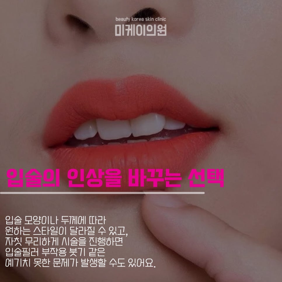 How to Avoid Swelling as a Lip Filler Side Effect image 2