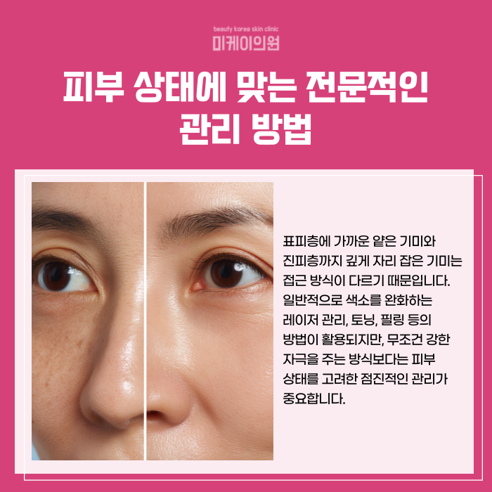 Can Melasma Be Removed in Just One Treatment at Gangnam Station? image 4