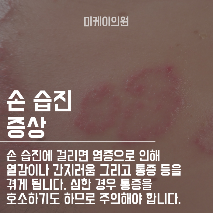 주부습진 원인 해결법 매끄러운 손 만들기 관련 이미지 2