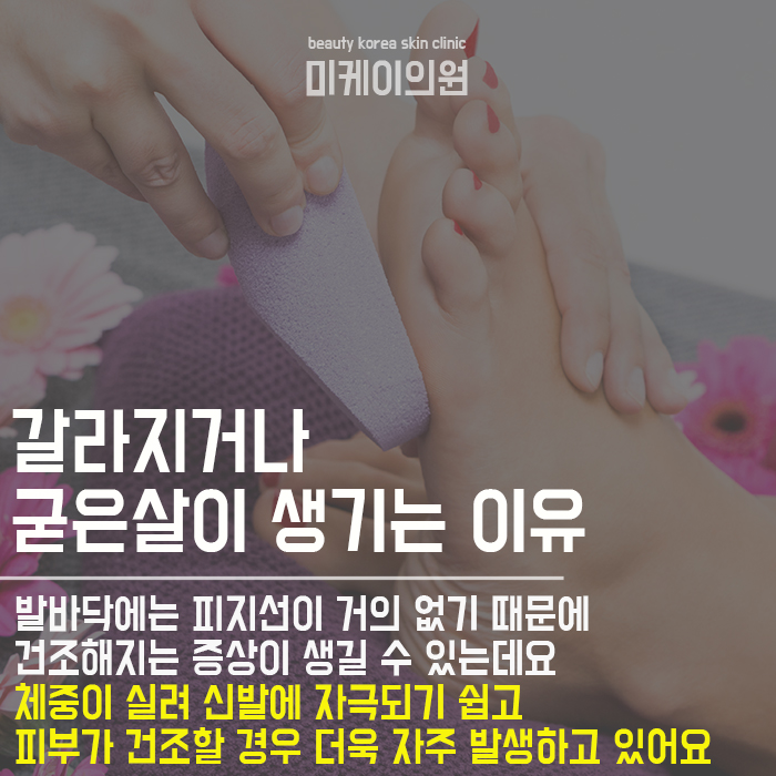 발각질관리하는팁 살펴보기 관련 이미지 2