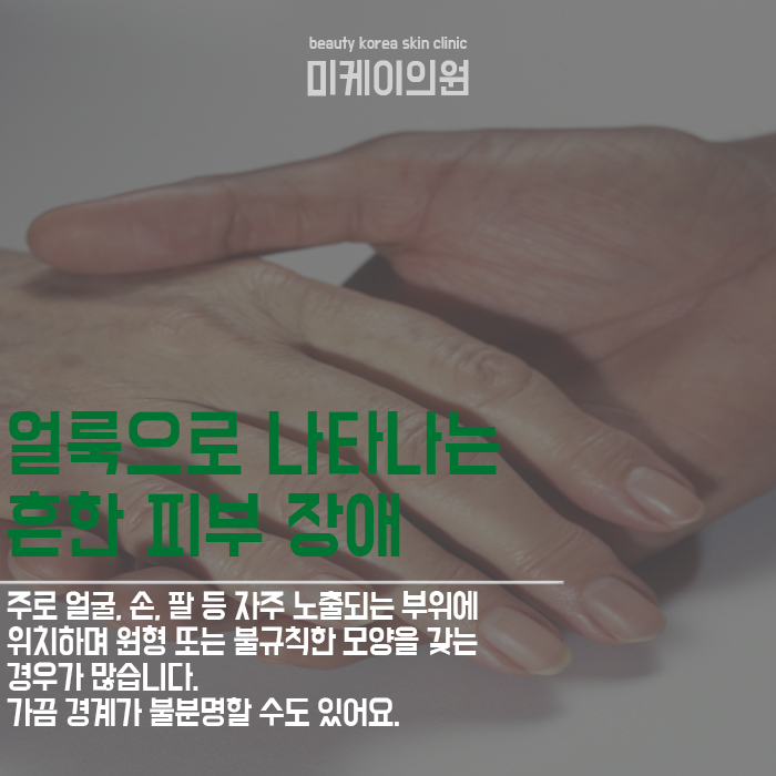 검버섯생기는이유와 치료 방법 관련 이미지 2