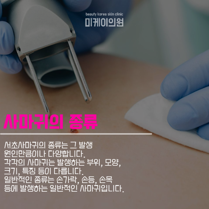 서초사마귀 고민되신다면 미케이로 관련 이미지 2
