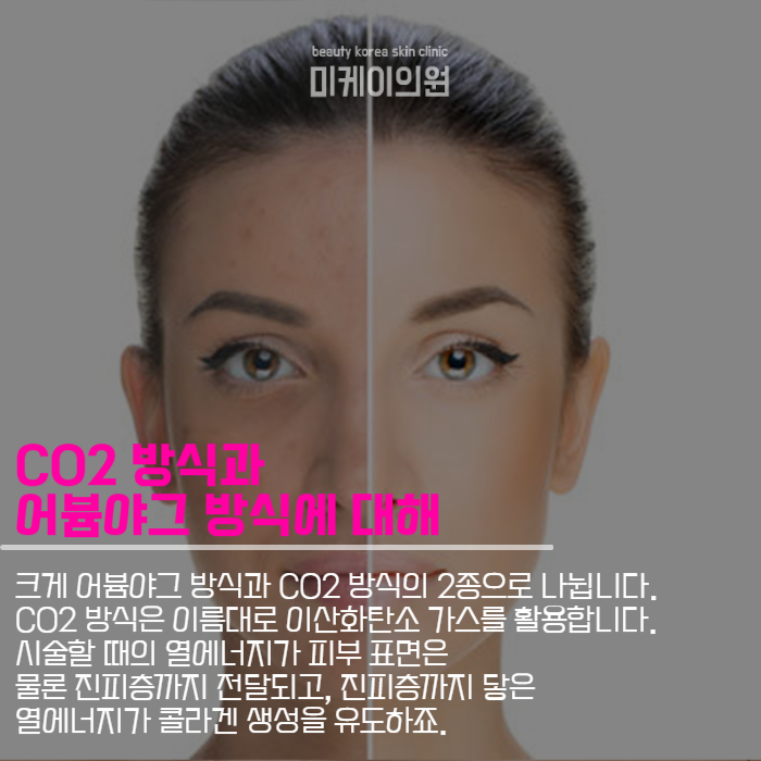 프락셀레이저 통증 부터 원리까지 관련 이미지 4