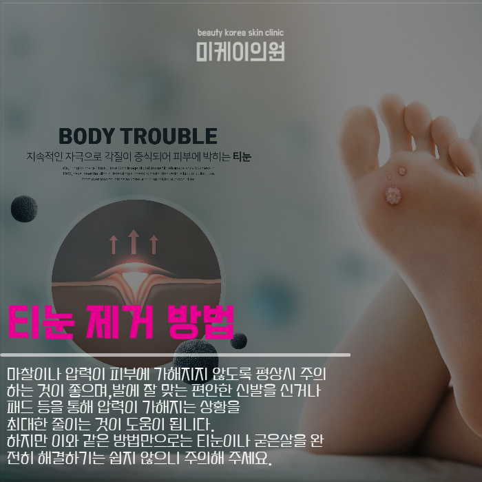 티눈생기는원인 및 케어법 알아보기 관련 이미지 4