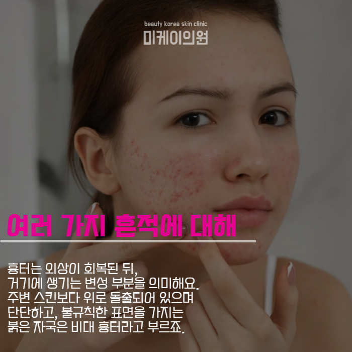 여드름자국치료 균일하고 매끄럽게 관련 이미지 2