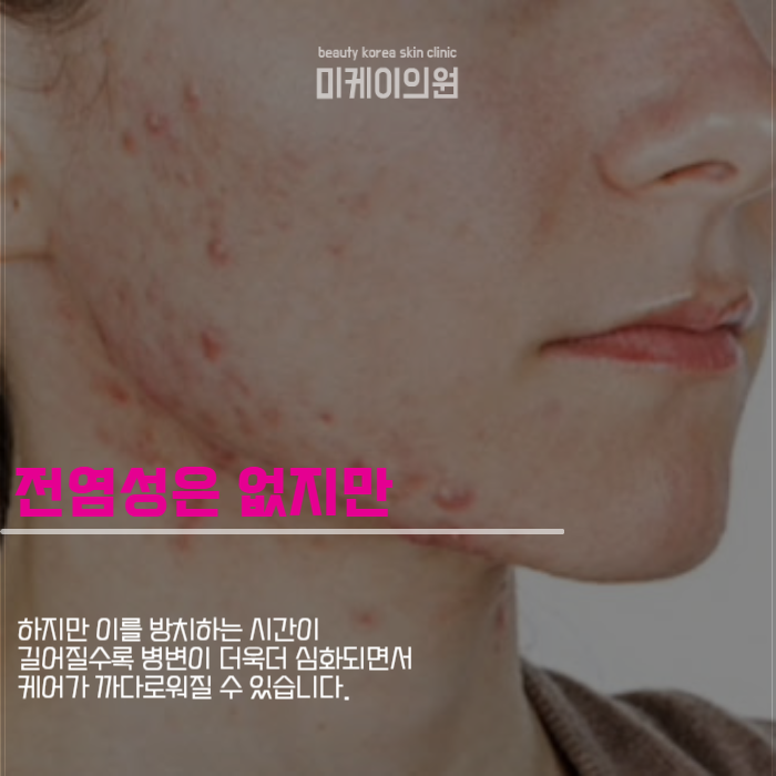 강남여드름피부 지긋지긋하다면 관련 이미지 3