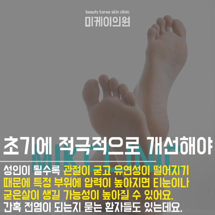 발바닥 티눈 원인 초기에 관리를 시작해요 관련 이미지 5