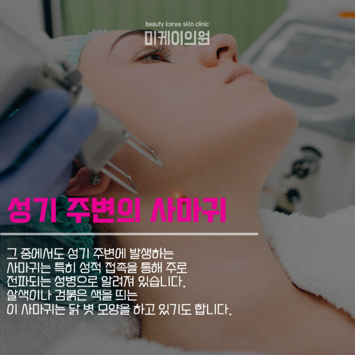 서초사마귀 고민되신다면 미케이로 관련 이미지 3