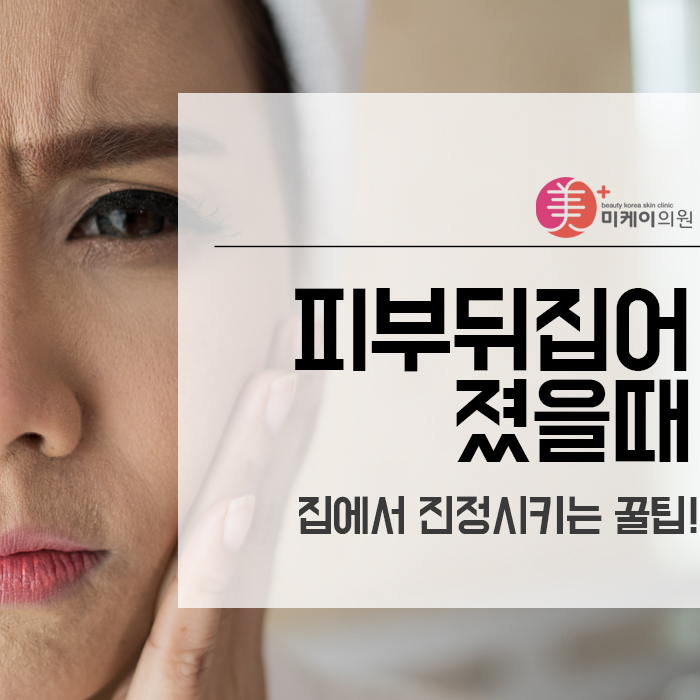 피부뒤집어졌을때 집에서 진정시키는 꿀팁! 관련 이미지 1