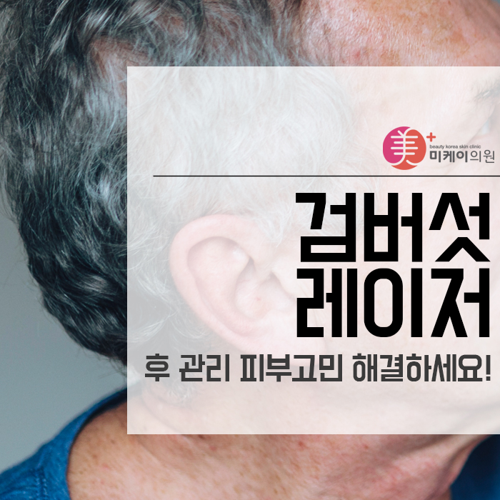 검버섯 레이저 후 관리 피부고민 해결하세요! 관련 이미지 1