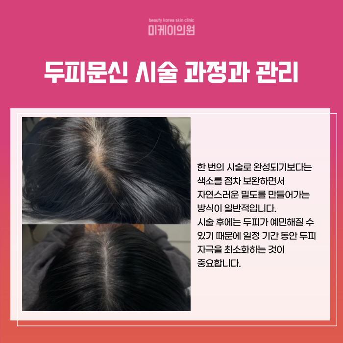 서초 두피문신 잘하는곳 티 안나게 관련 이미지 5