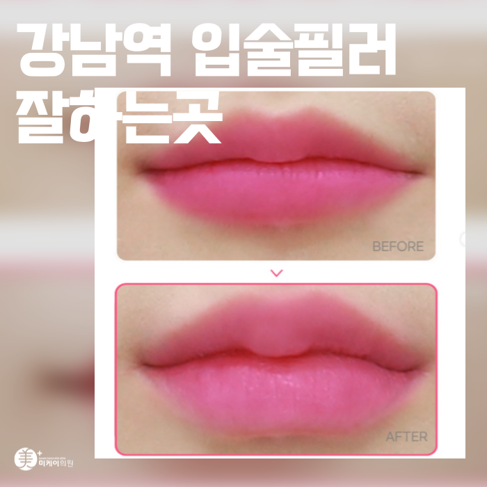 Where to Get Lip Fillers Near Gangnam Station: A Natural Design image 1
