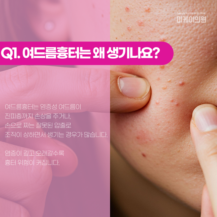 Why Don’t Gangnam Acne Scars Disappear on Their Own? image 2