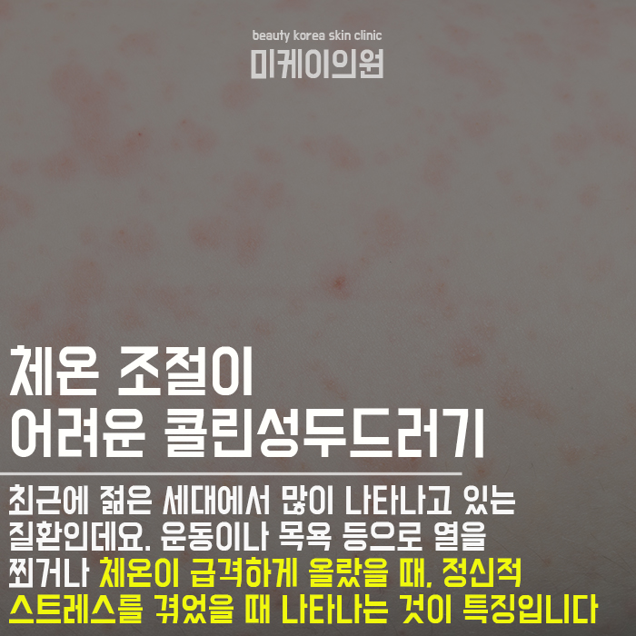 모기물린것처럼 두드러기 올라온다면 긁지마세요 관련 이미지 2
