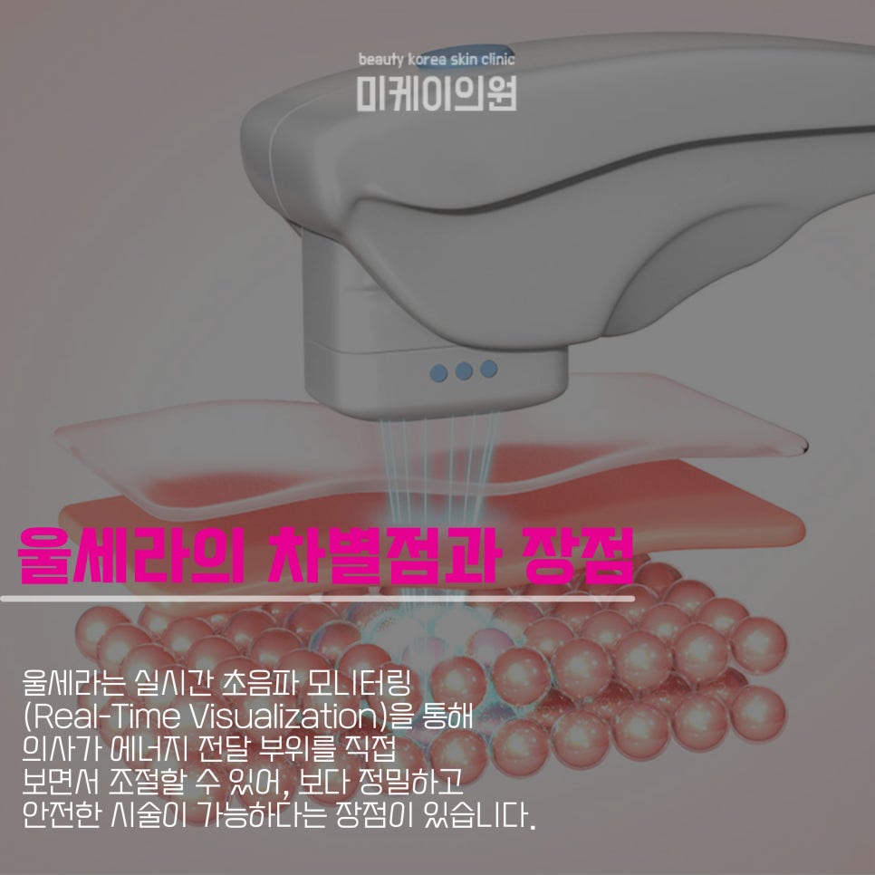 울쎄라 부작용 볼패임 미리 알아두기 관련 이미지 3