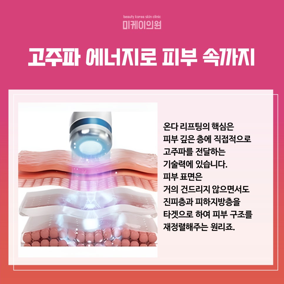 The Trending Treatment Recommended by Gangnam Dermatology Clinics: Onda Lifting image 3