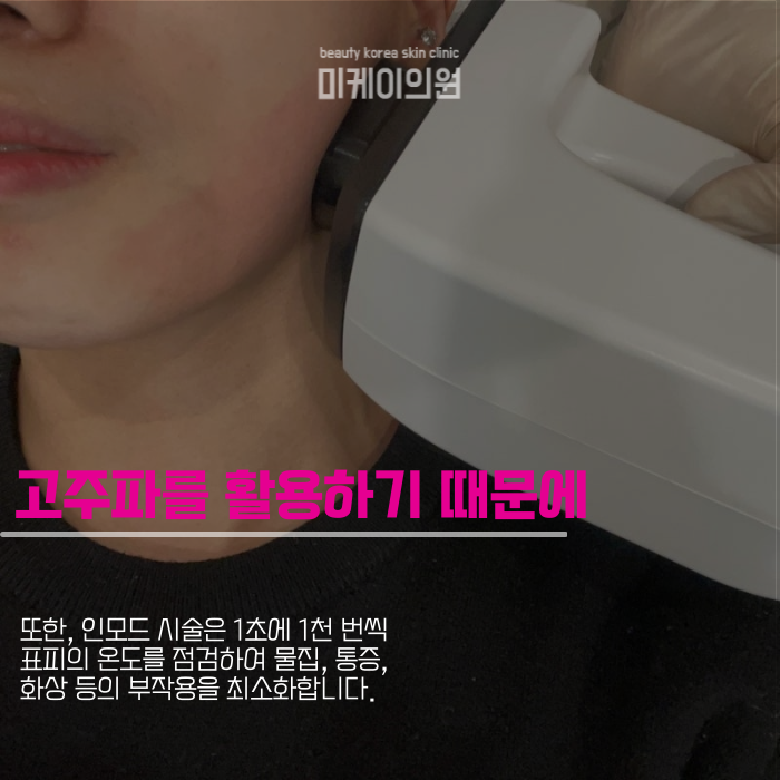 인모드 FORMA FX 차이 알아보고 활용하기 관련 이미지 4