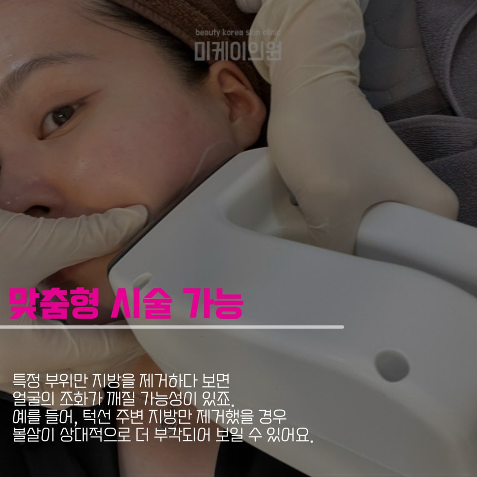 이중턱지방흡입부작용 피하려면 관련 이미지 5