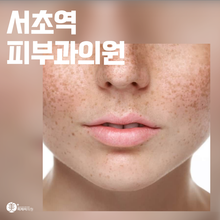 서초역 피부과의원 기미 고민이 깊어질 때 맞는 주사 관련 이미지 1