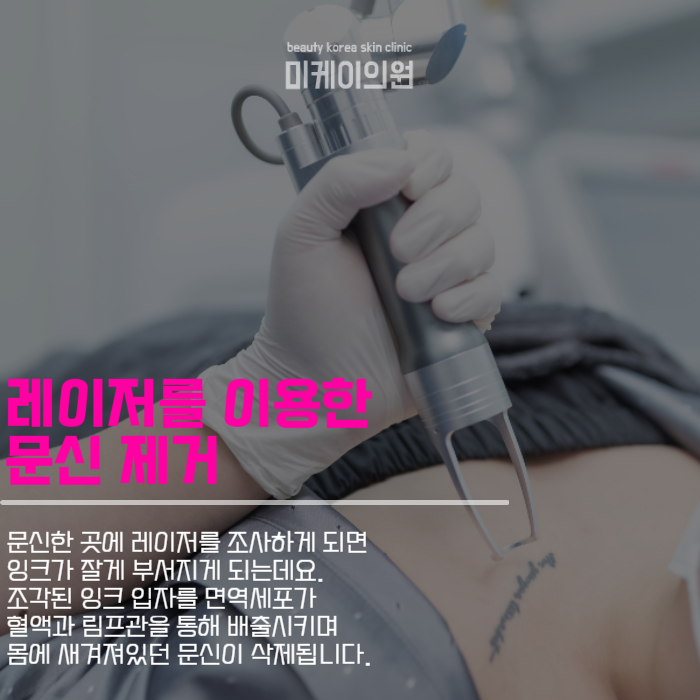 문신제거기간 및 주의사항 살펴보기 관련 이미지 2