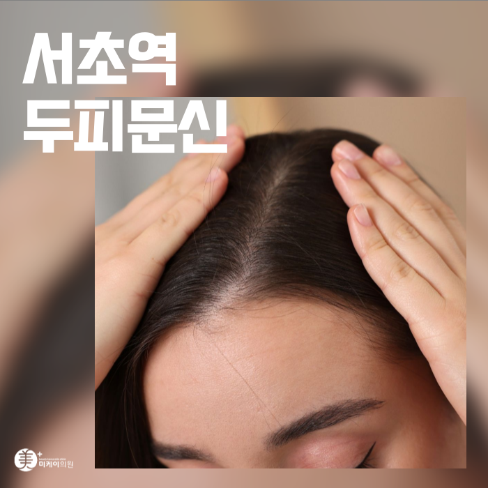 Sopoong Station Scalp Micropigmentation for a Natural-Looking Cover image 1