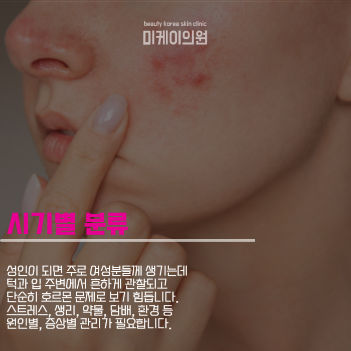 강남여드름피부 지긋지긋하다면 관련 이미지 2