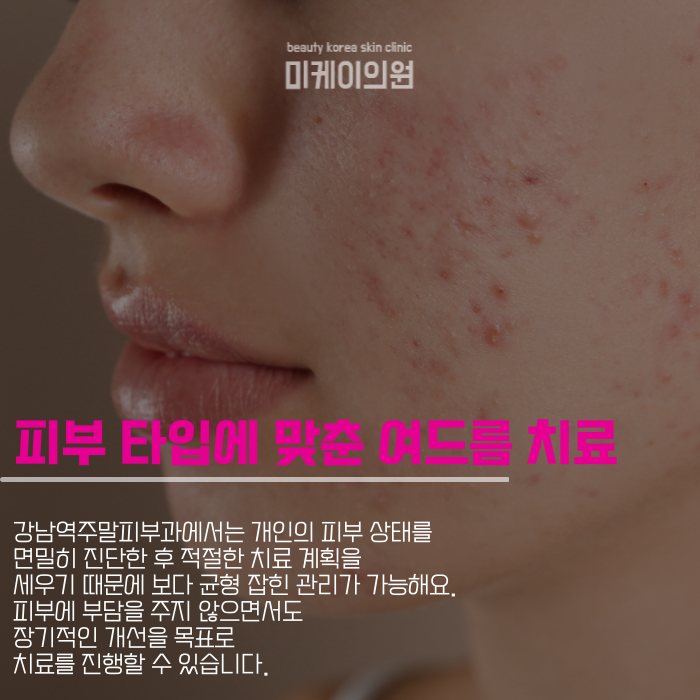 강남역주말피부과에서 피부 타입별 여드름 치료 관련 이미지 2